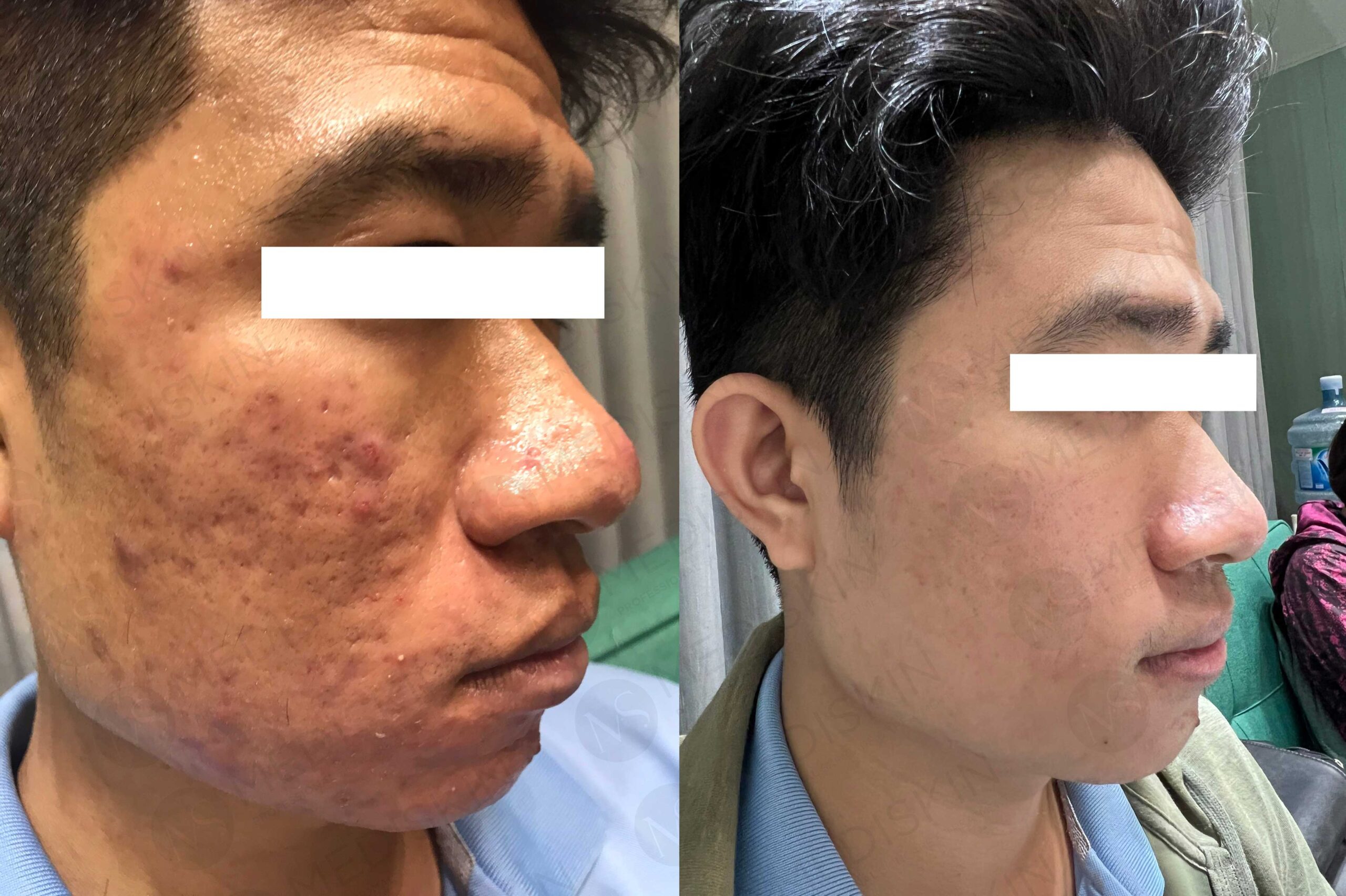 MediSkin – Điều Trị Sẹo Rỗ