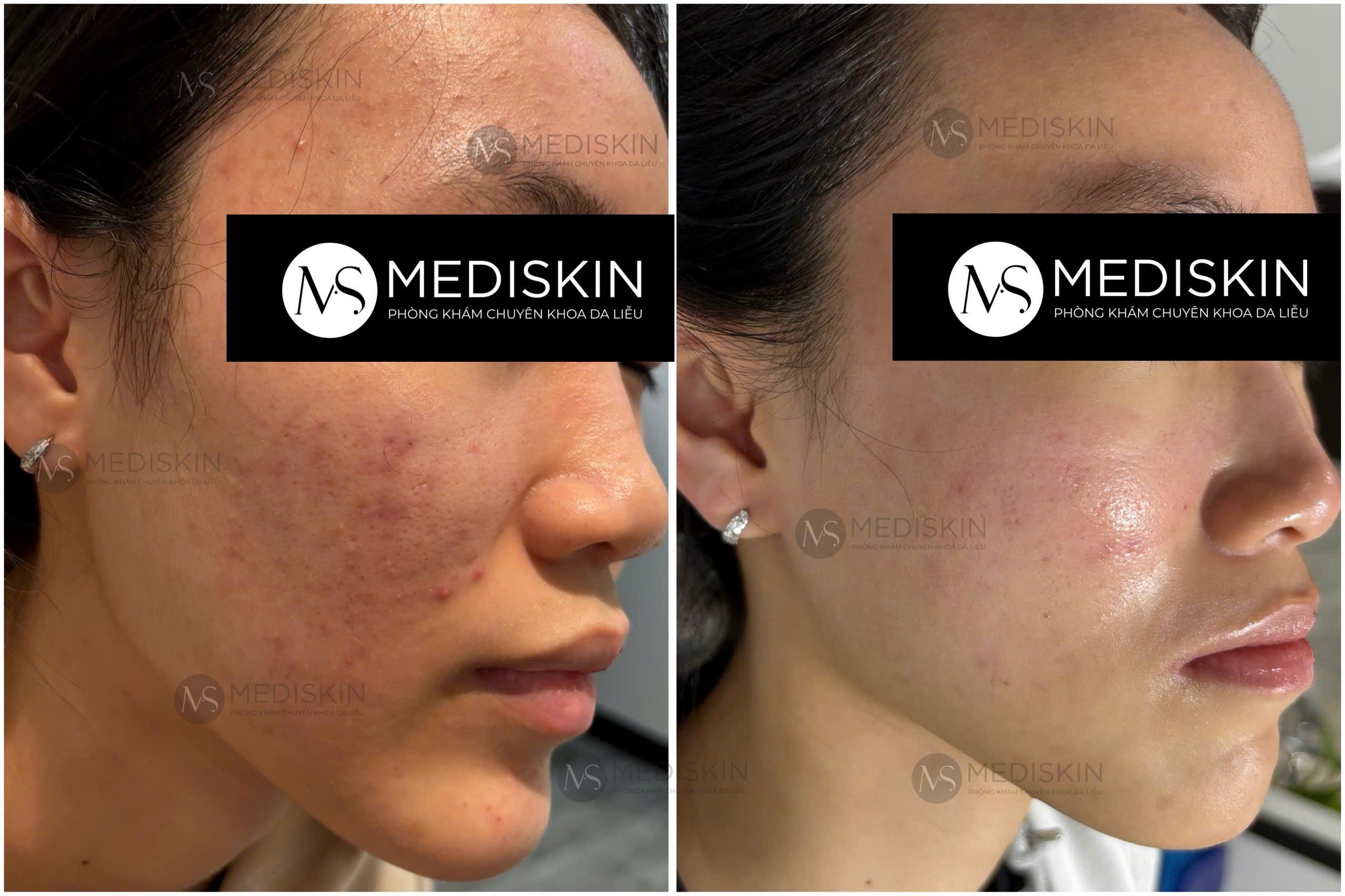 điều trị mụn long an