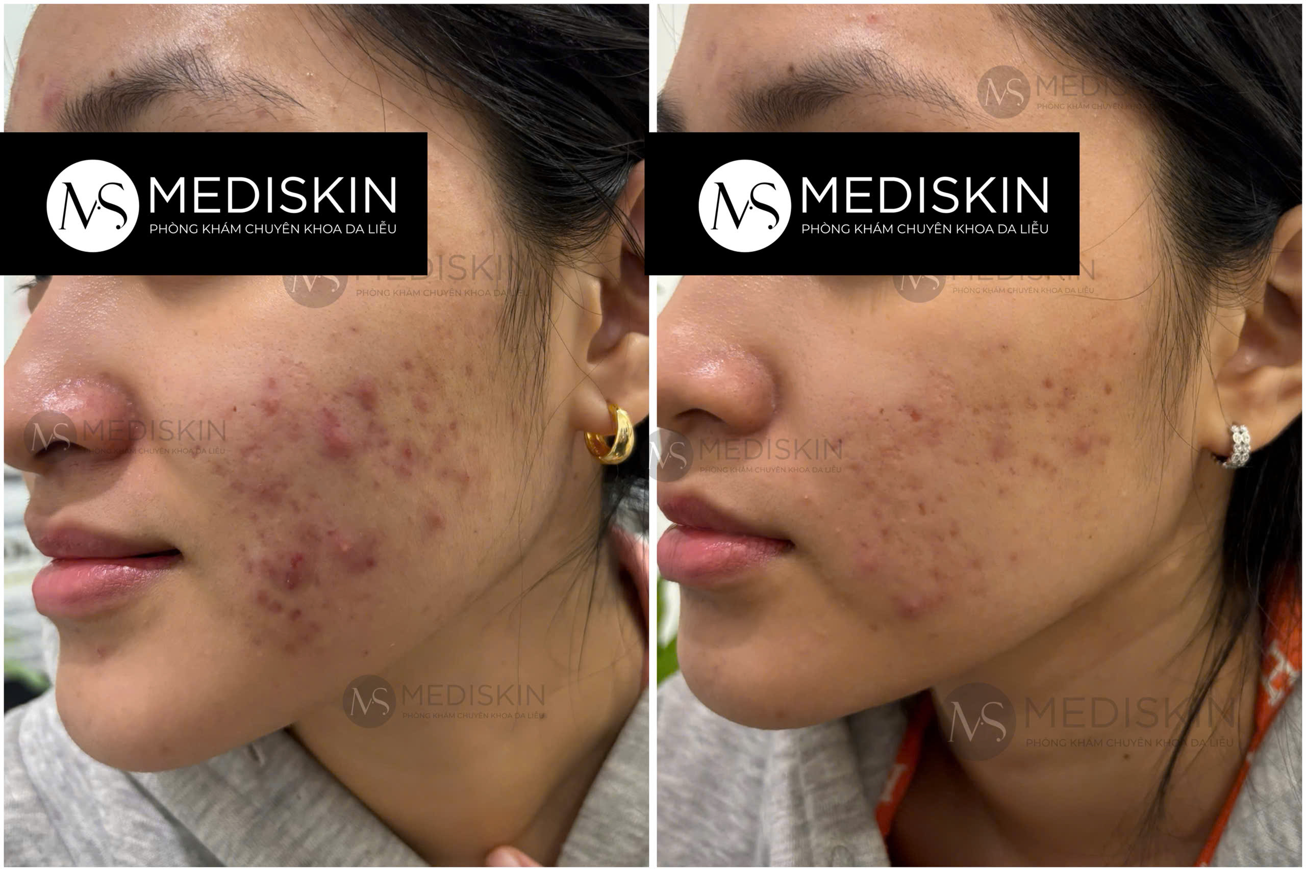 điều trị mụn long an