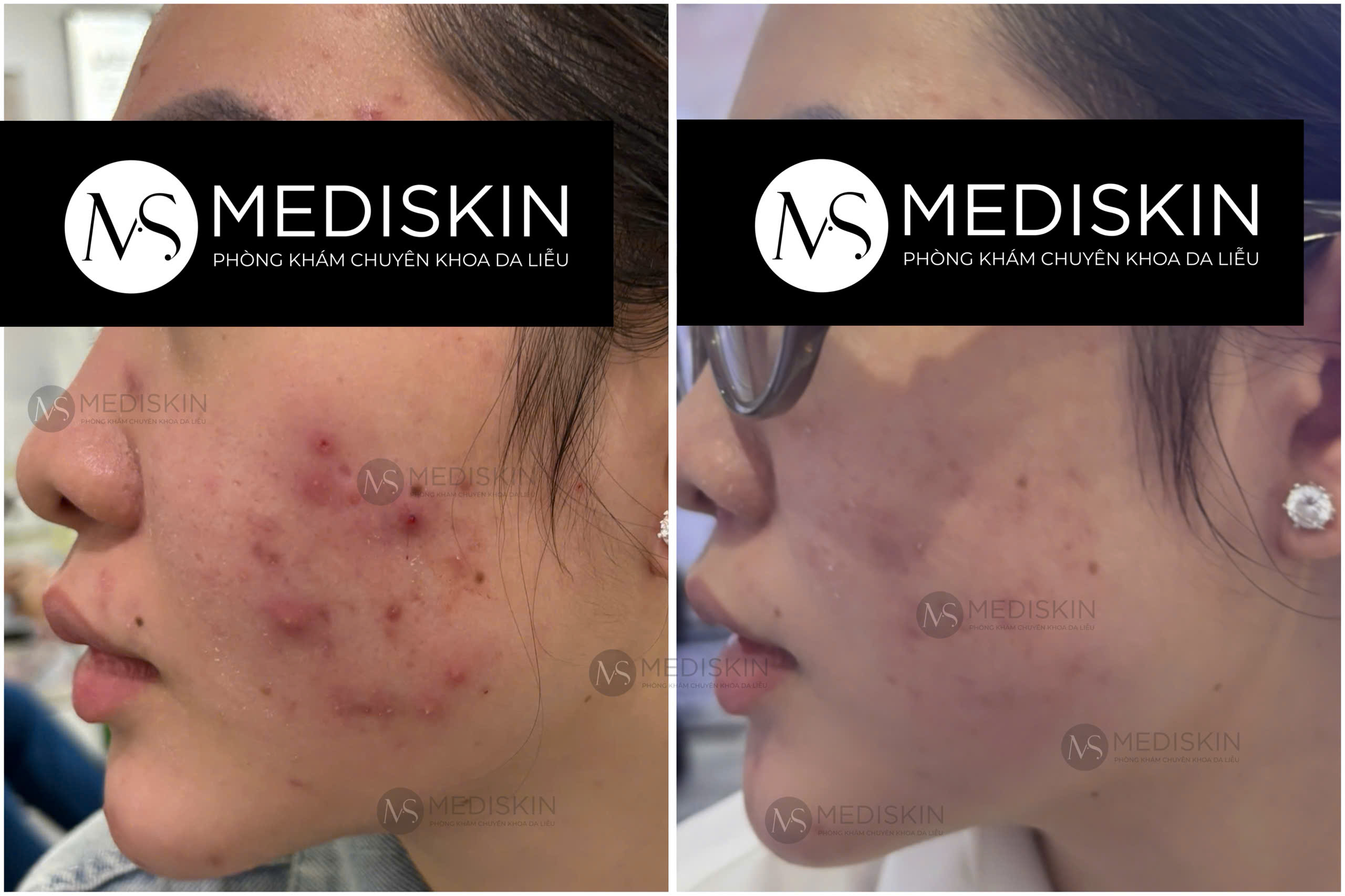 điều trị mụn long an mediskin