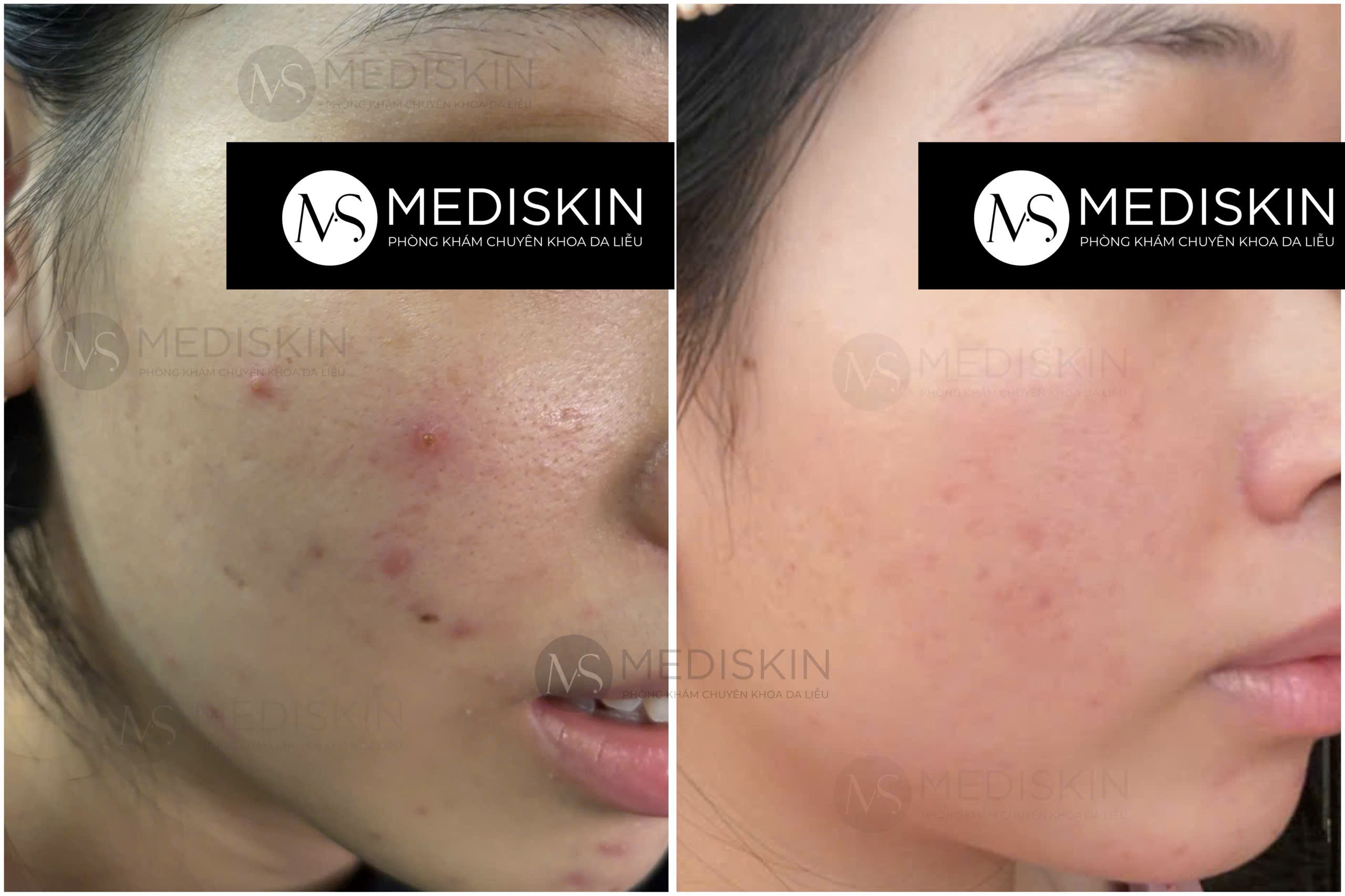 điều trị mụn thâm long an