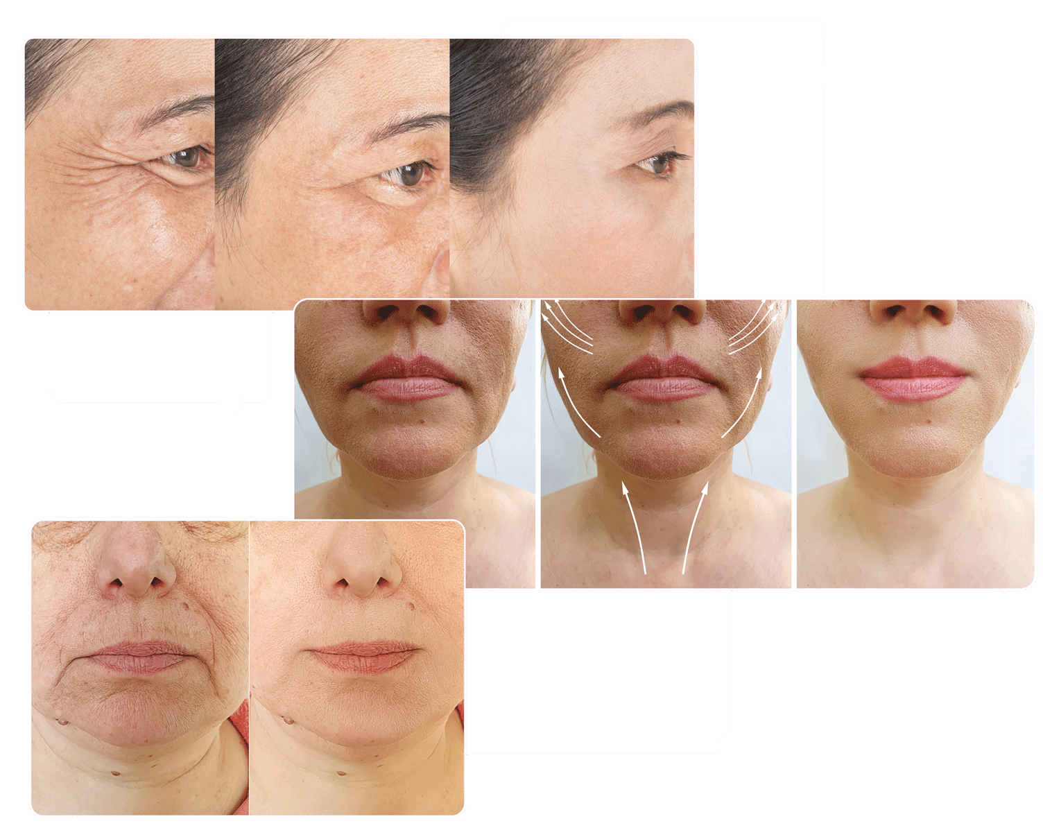 MediSkin – Tiêm Botox Long An