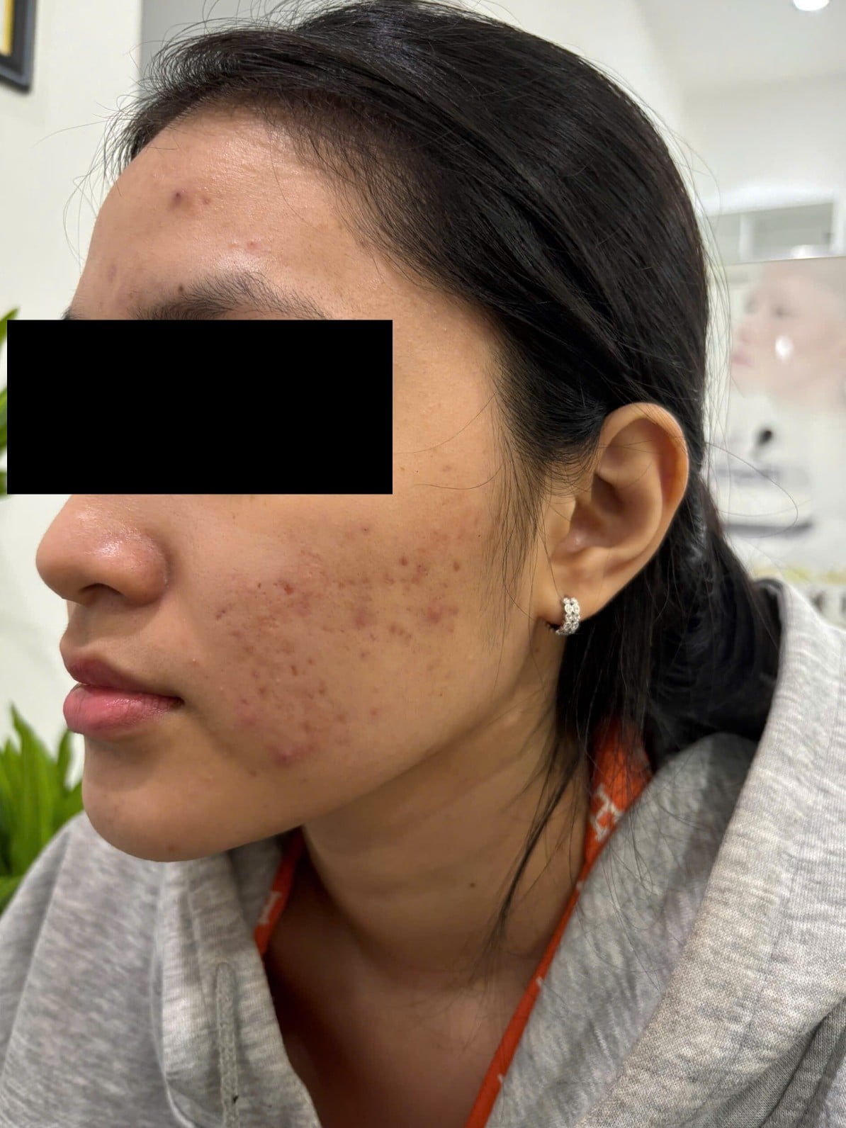 Trước điều trị tại MediSkin Long An