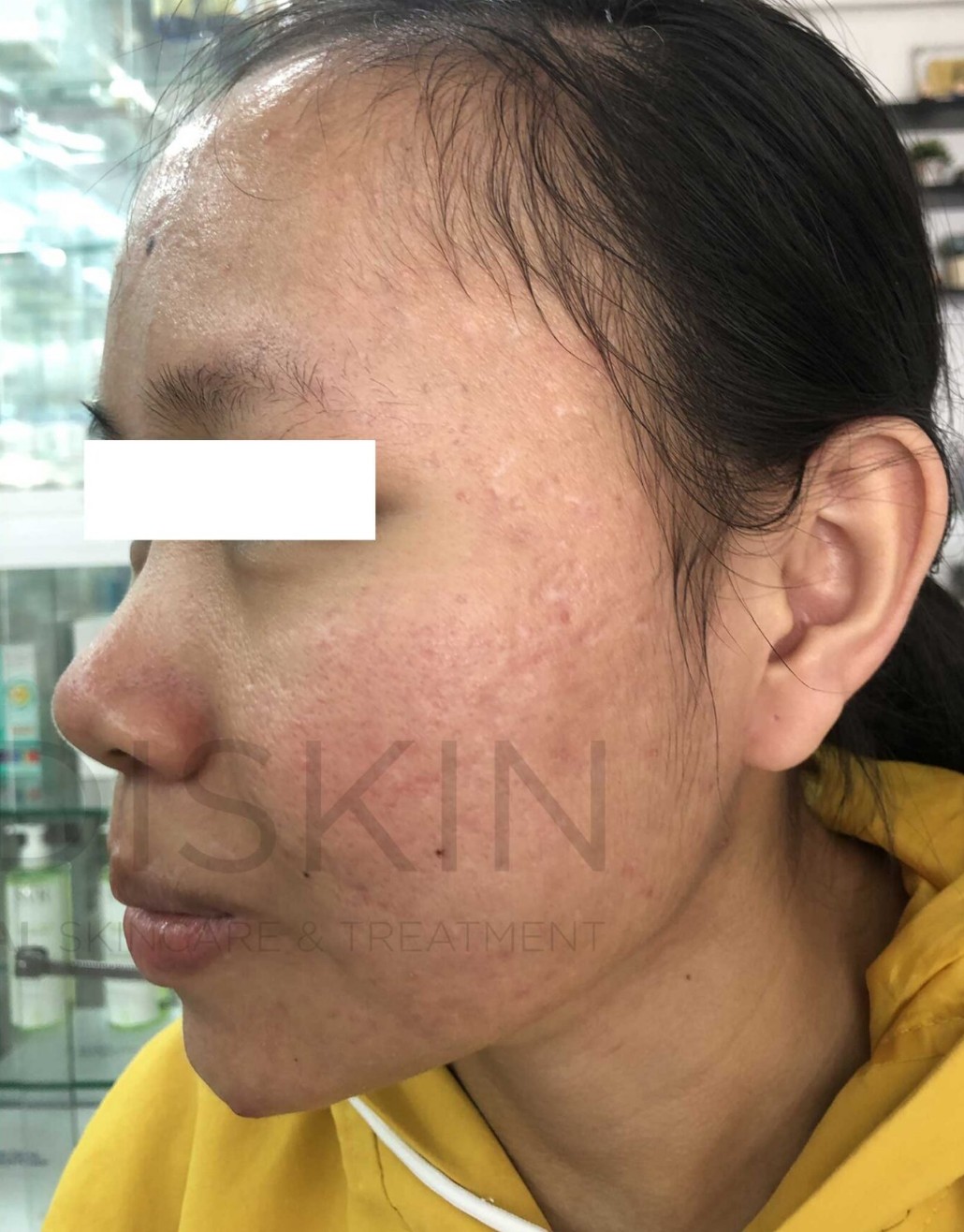 Truoc dieu tri tai MediSkin Long An