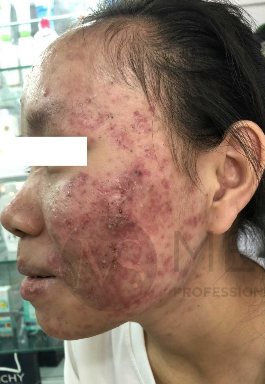 Sau dieu tri tai MediSkin Long An