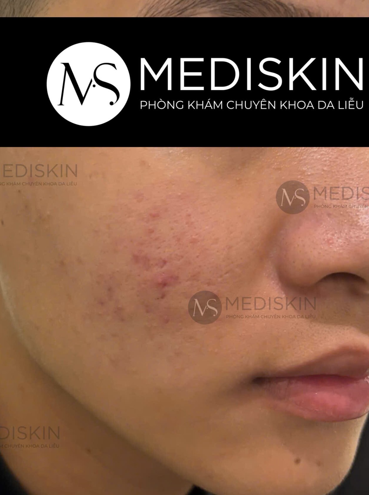 Truoc dieu tri tai MediSkin Long An