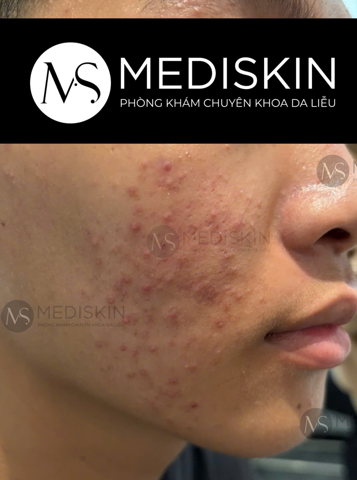 Sau dieu tri tai MediSkin Long An