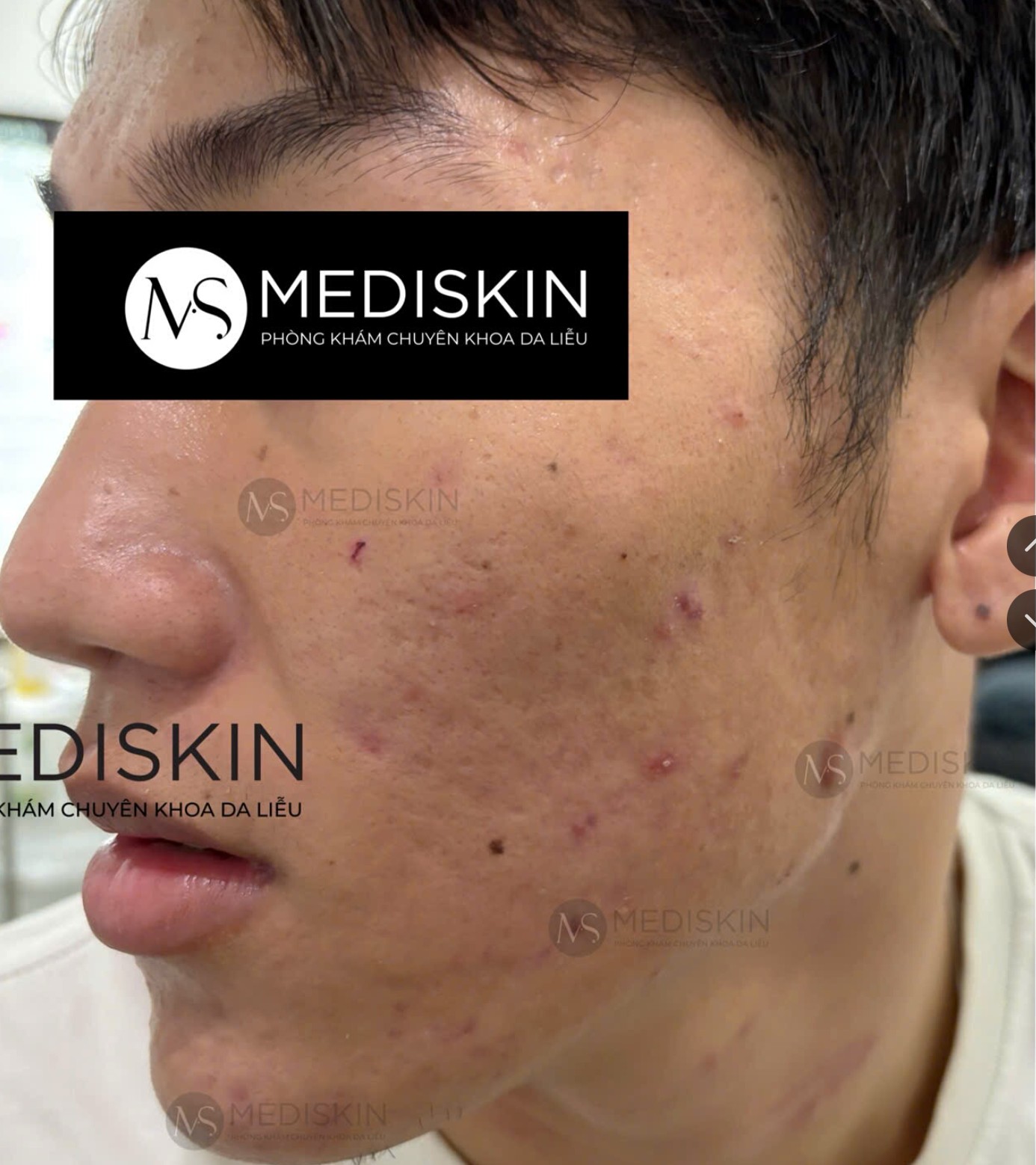 Truoc dieu tri tai MediSkin Long An