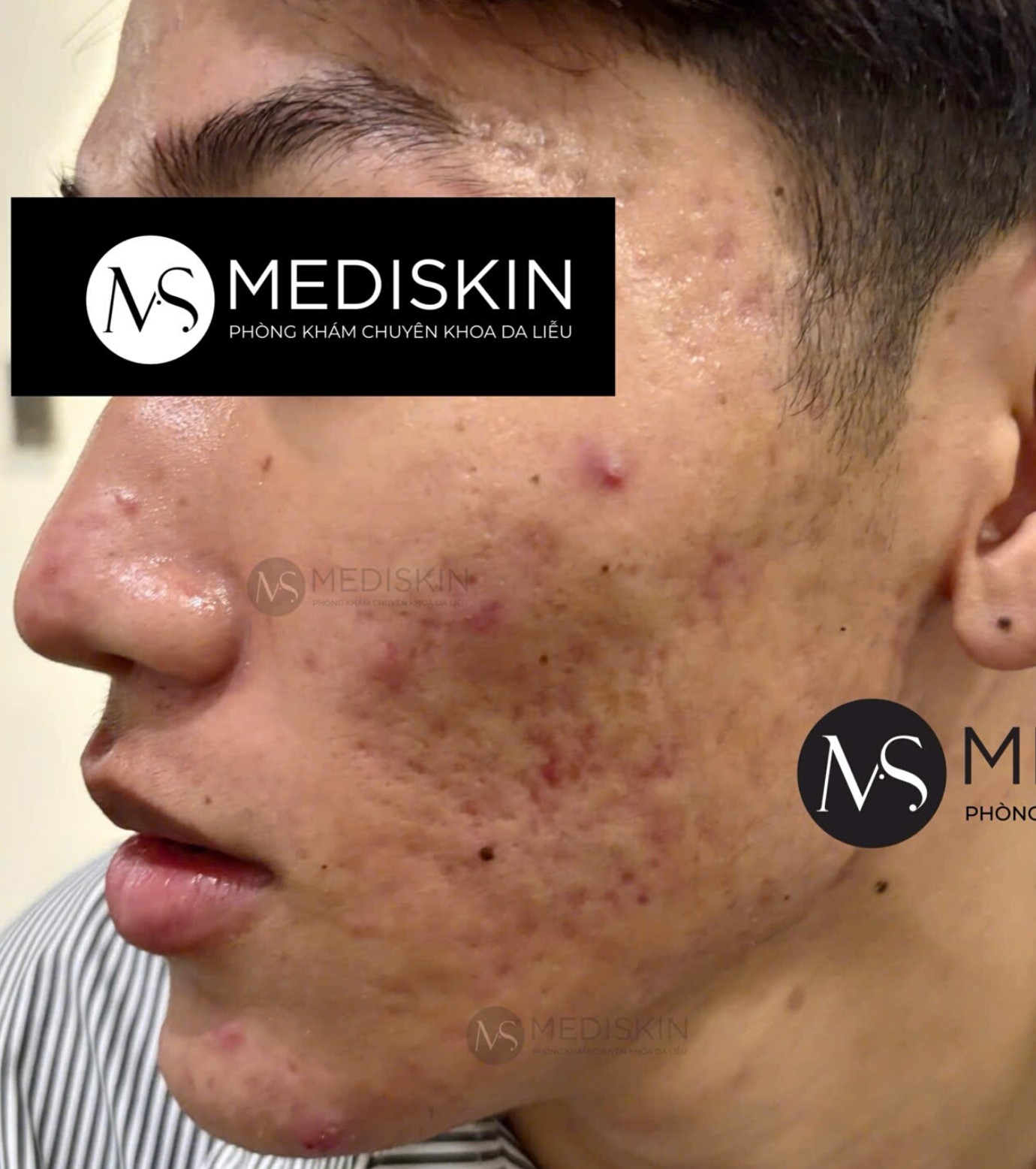 Sau dieu tri tai MediSkin Long An