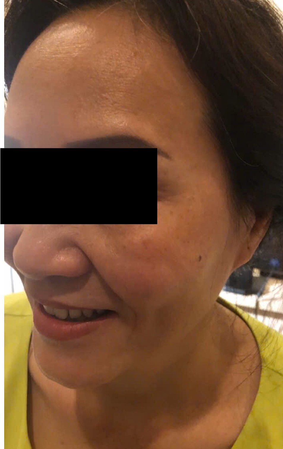 Truoc dieu tri tai MediSkin Long An