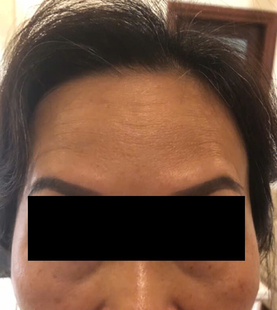 Truoc dieu tri tai MediSkin Long An