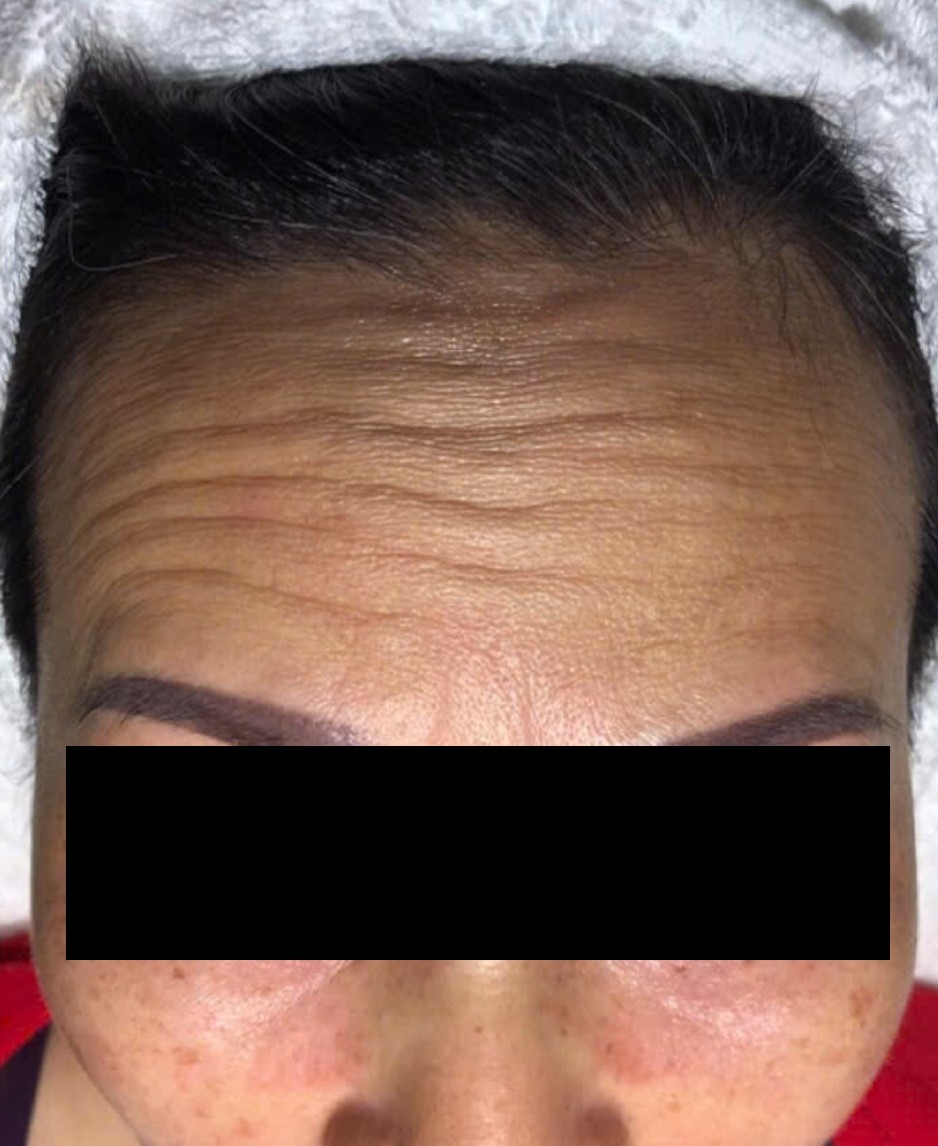 Sau dieu tri tai MediSkin Long An
