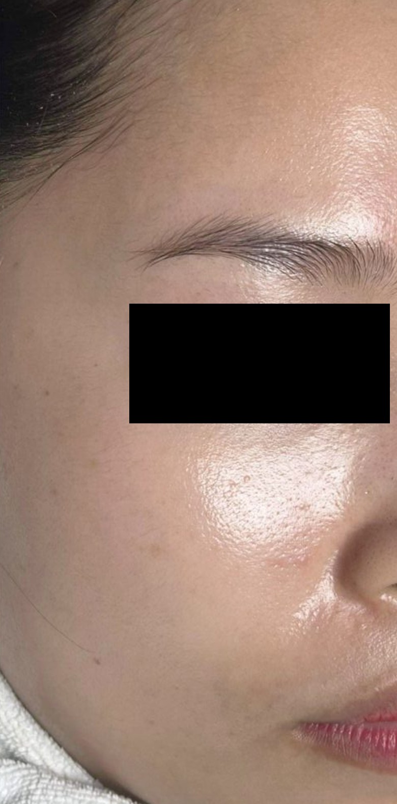 Trước điều trị tại MediSkin