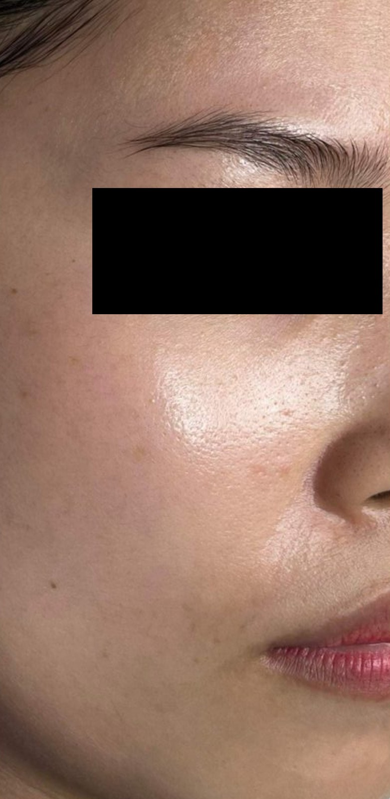 Sau điều trị tại MediSkin