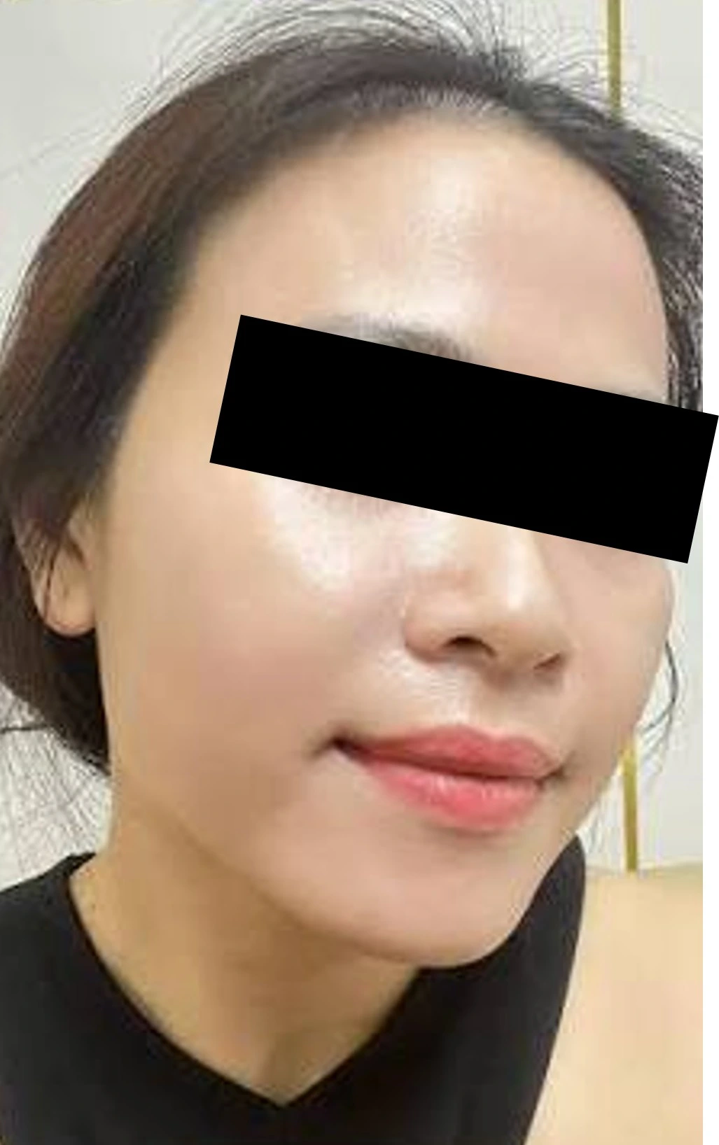 Trước điều trị tại MediSkin