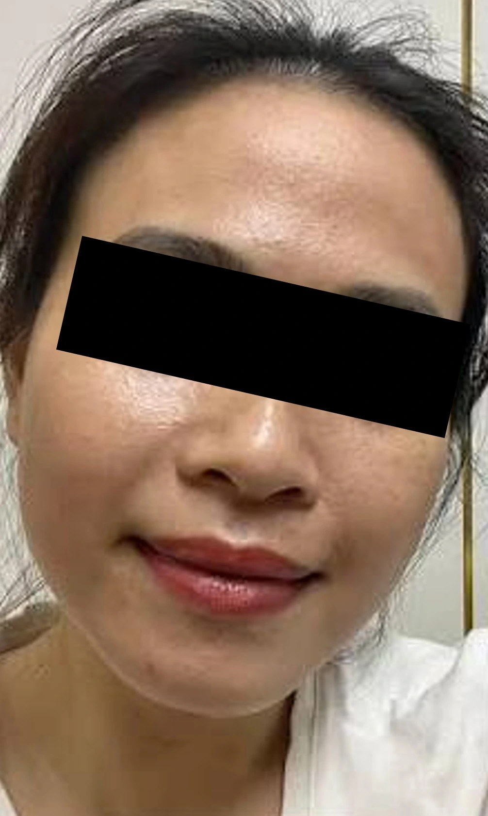 Sau điều trị tại MediSkin