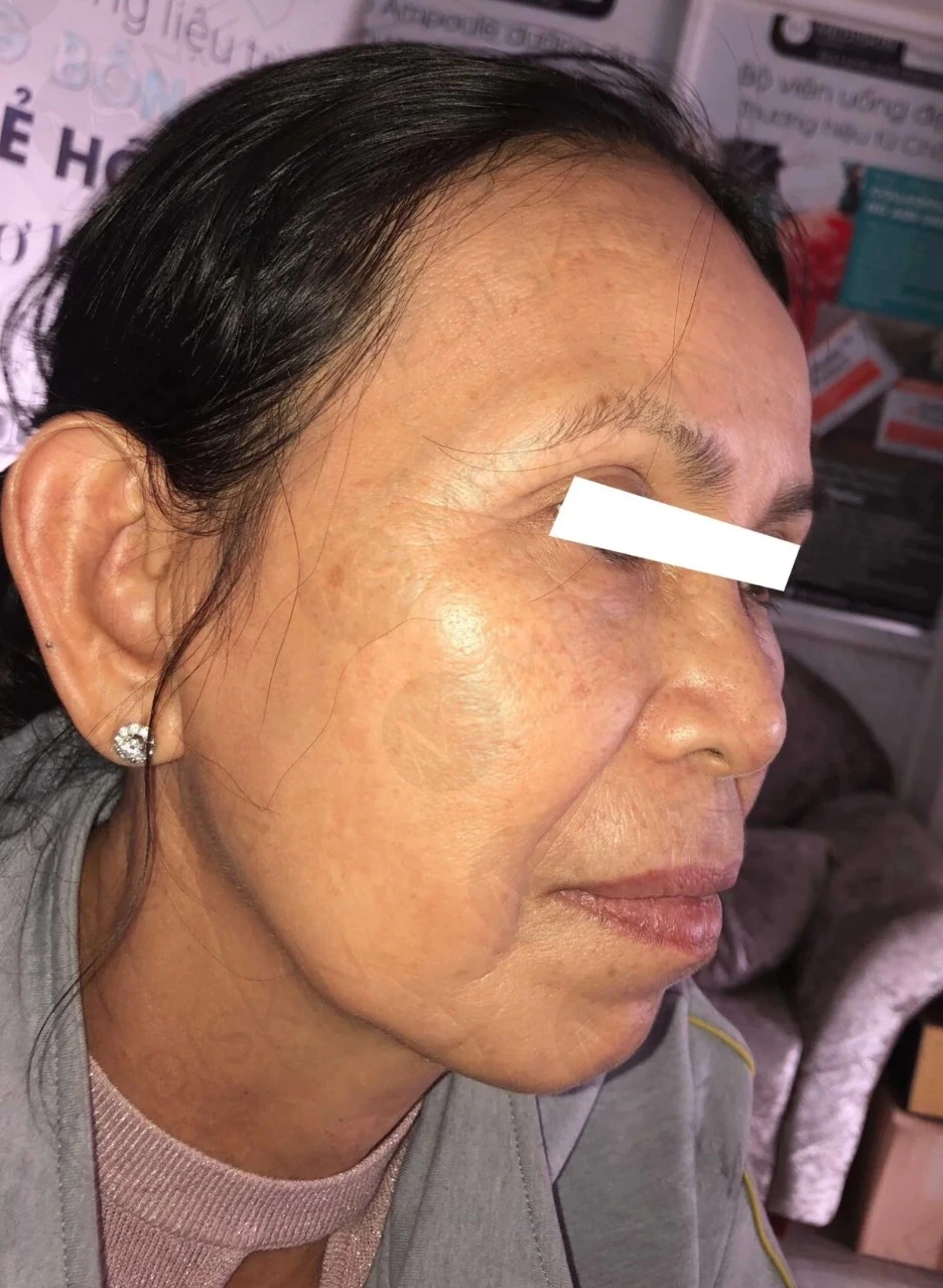 Truoc dieu tri tai MediSkin Long An