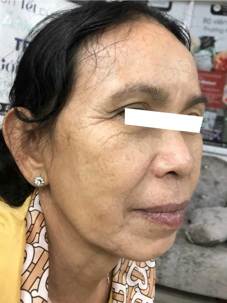 Sau dieu tri tai MediSkin Long An